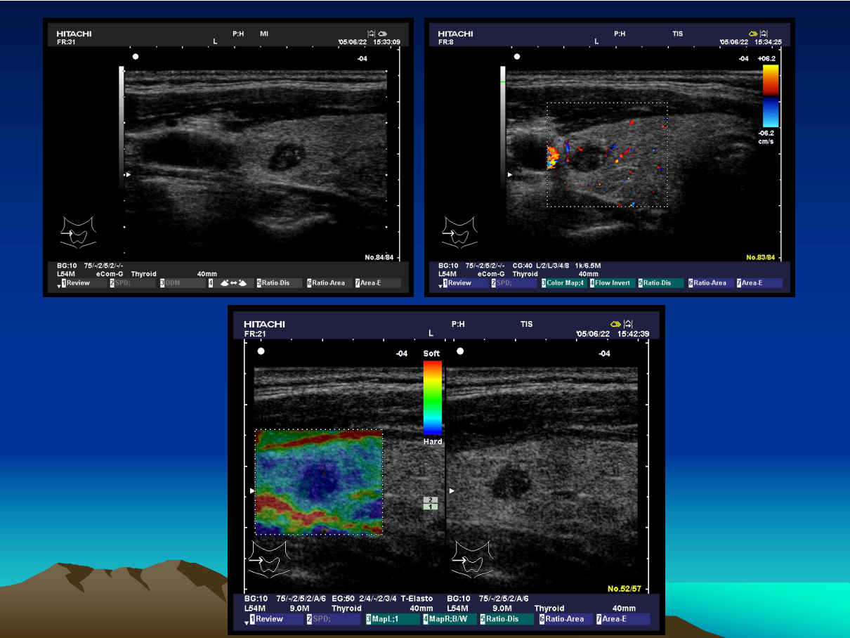 Elastography — tissue stiffness measurement; stiff lesions (thyroid, liver fibrosis) raise malignancy/cirrhosis suspicion.