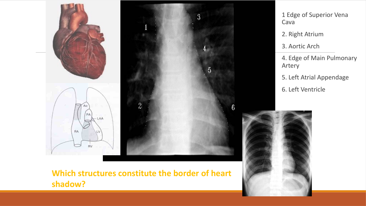 Cardiac silhouette — right border: SVC/aorta + right atrium; left border: aortic knuckle + pulmonary trunk + LA appendage + left ventricle; double density = enlarged left atrium.