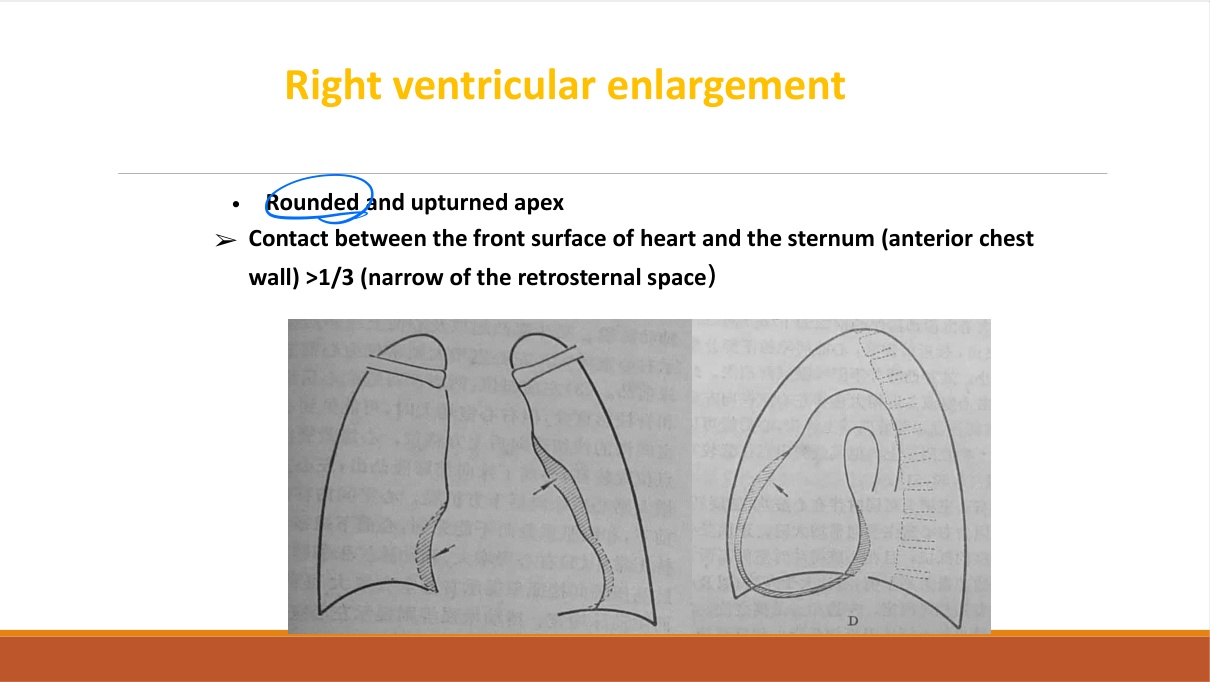 Aortic dissection on CT aortogram — intimal flap, true/false lumen, Stanford A (ascending, surgical) vs B (descending, medical).