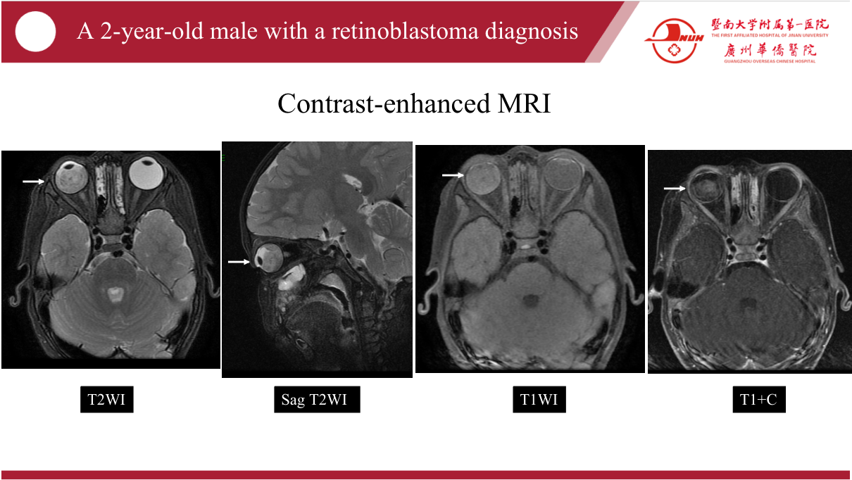 NPC imaging workup — MRI (tumour extent, skull-base/foramina, nodes) + CT (bone erosion) + nasopharyngoscopy + biopsy; EBV DNA for monitoring.