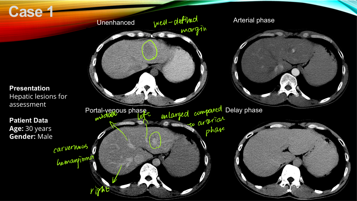 Focal liver lesions the big four enhancement patterns: hemangioma (peripheral nodular fill), HCC (arterial hyperenhancement + washout + capsule), FNH (homogeneous + central scar), metastasis (rim + washout).
