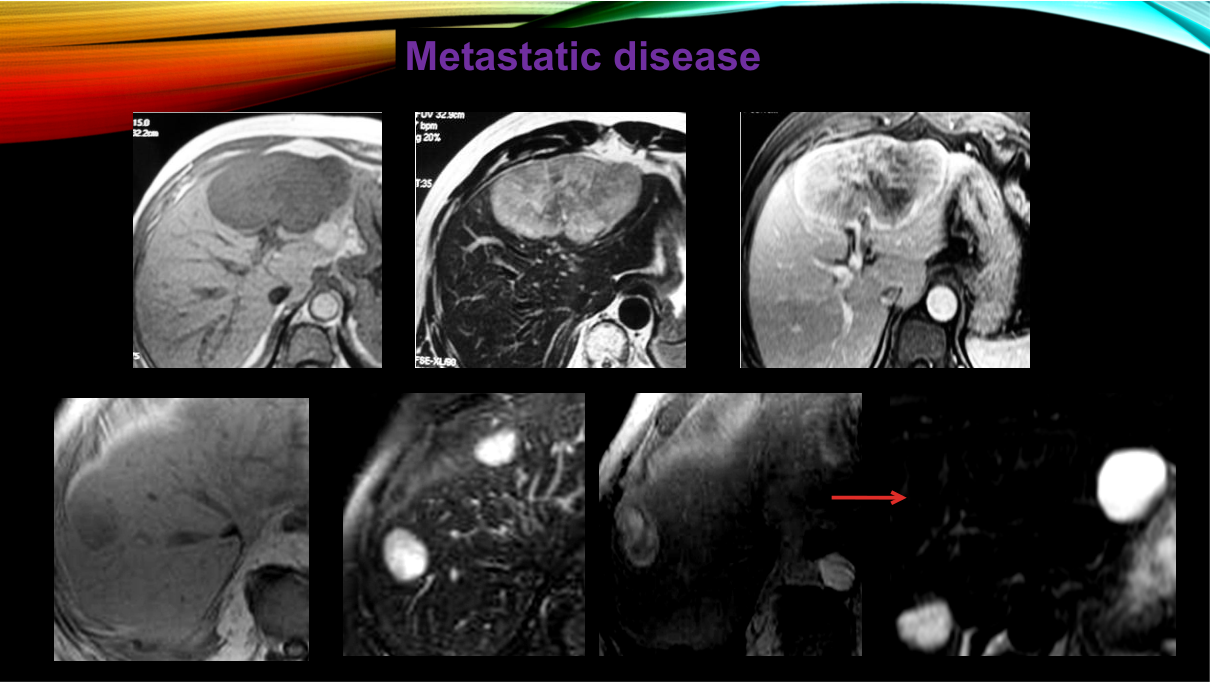Liver case discussion abscess (rim enhancement, fever), metastasis (multiple, rim), cholangiocarcinoma (delayed progressive enhancement, capsular retraction).