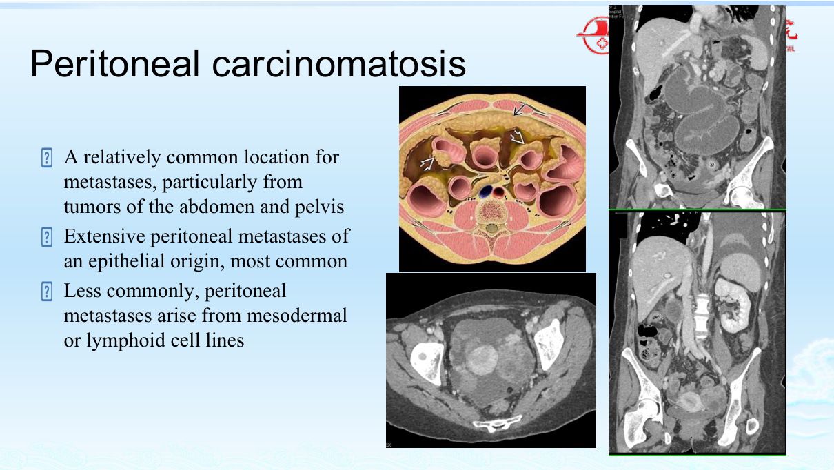 Appendicitis on CT — dilated appendix >6 mm with wall thickening and periappendiceal fat stranding; complications include abscess and perforation.