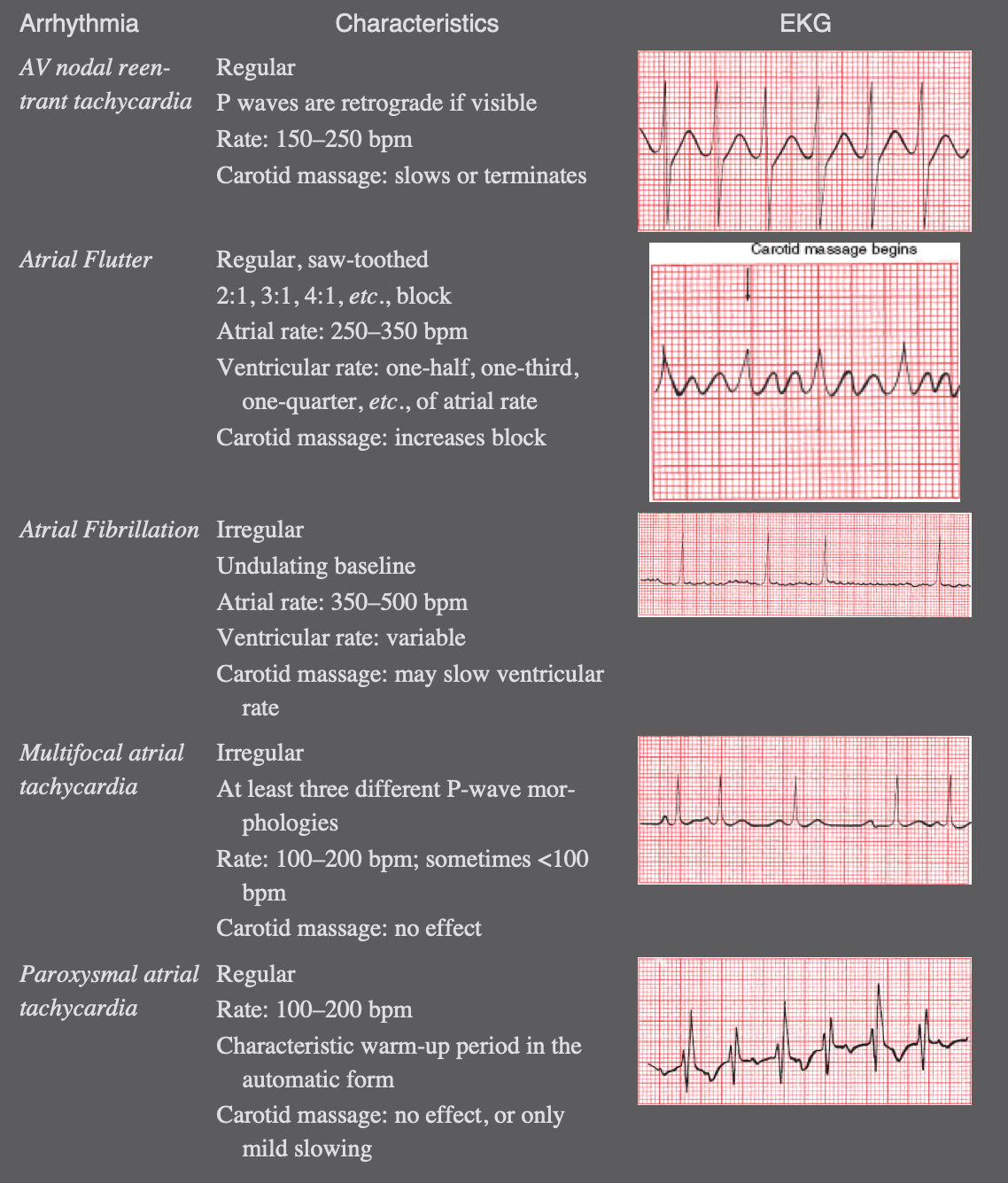 AVNRT example
