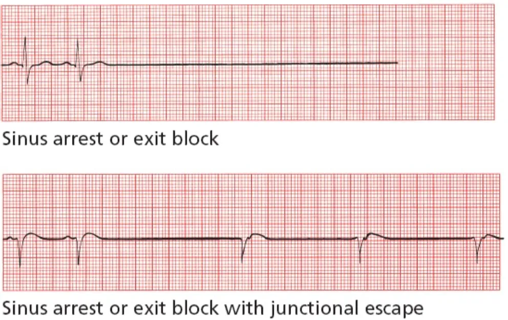 Sinus arrest/exit block