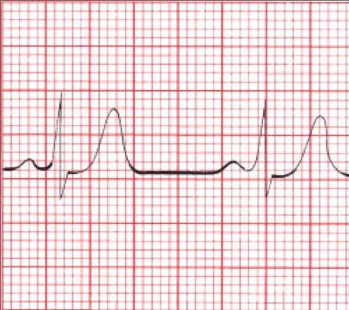 Hyperkalemia - peaked T waves