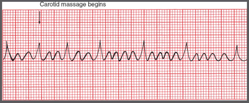 3:1 Atrial flutter