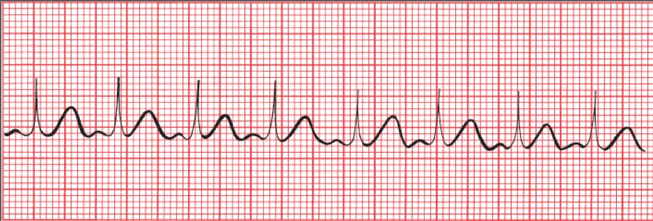 Sinus tachycardia
