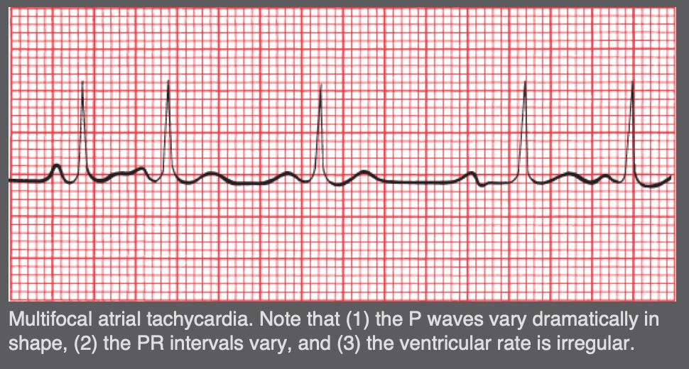 Multifocal atrial tachycardia