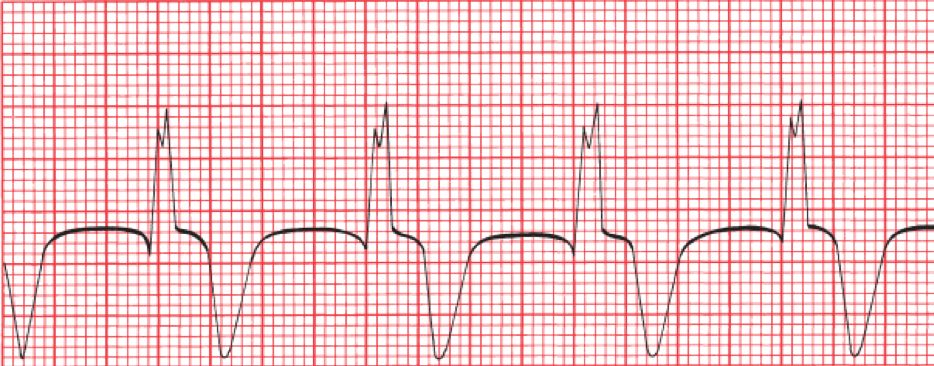 Accelerated idioventricular rhythm