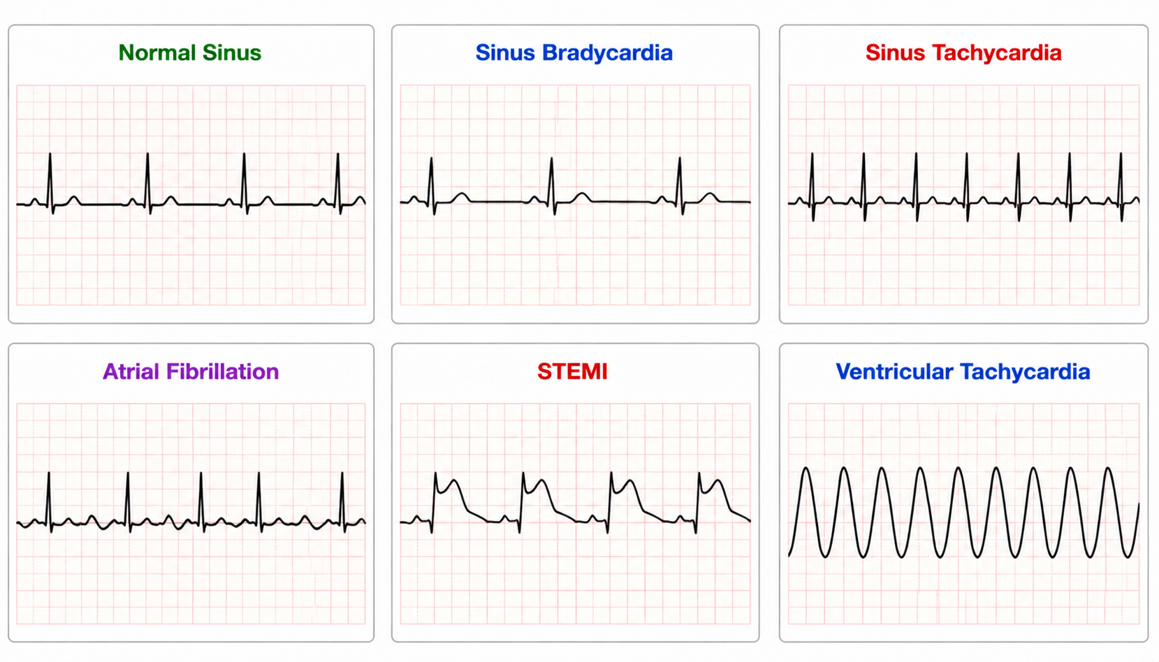 Six high-yield ECG rhythms — normal sinus, bradycardia, tachycardia, AF, STEMI, VT (六大心电节律速查图)