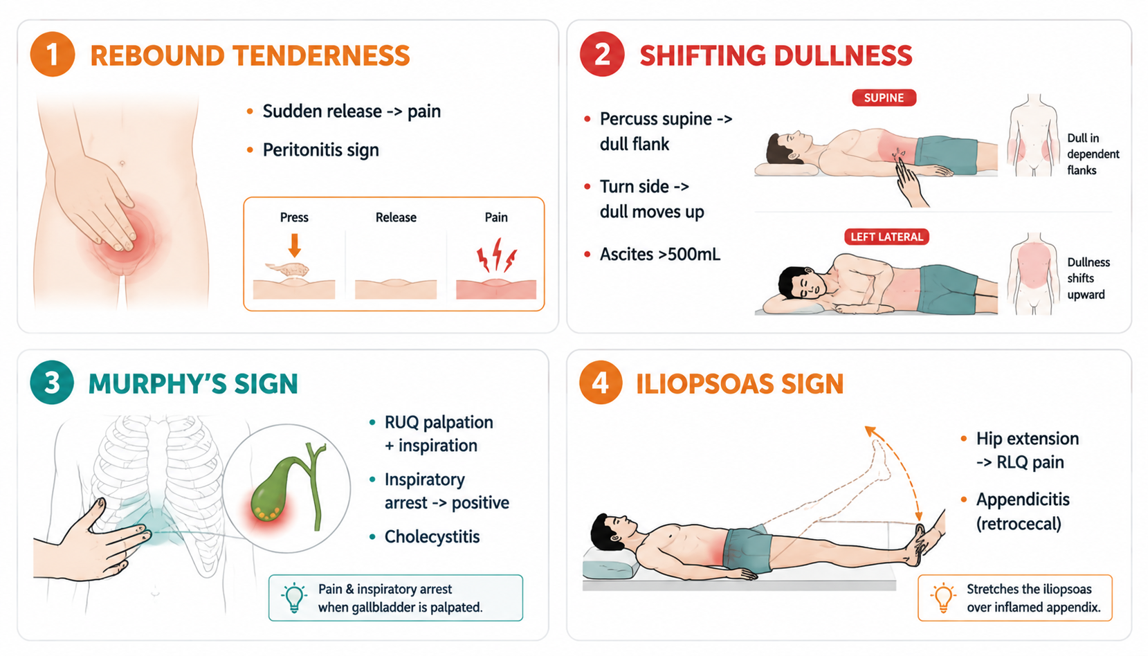 Special abdominal signs — rebound, shifting dullness, Murphy's, psoas (腹部特殊体征检查法)