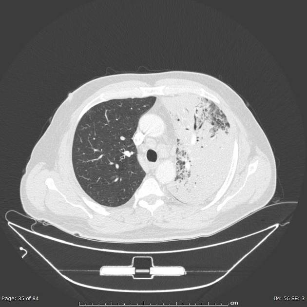 Lobar pneumonia — consolidation with air bronchogram