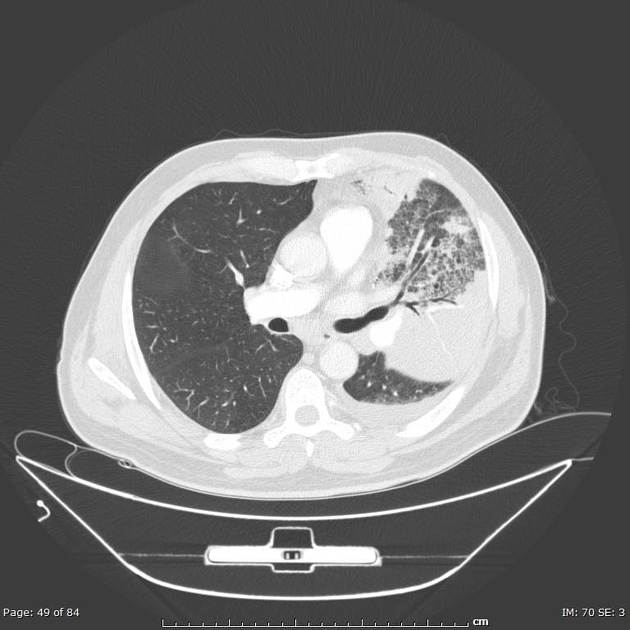 Lobar pneumonia — consolidation with air bronchogram