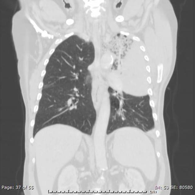 Lobar pneumonia — consolidation with air bronchogram