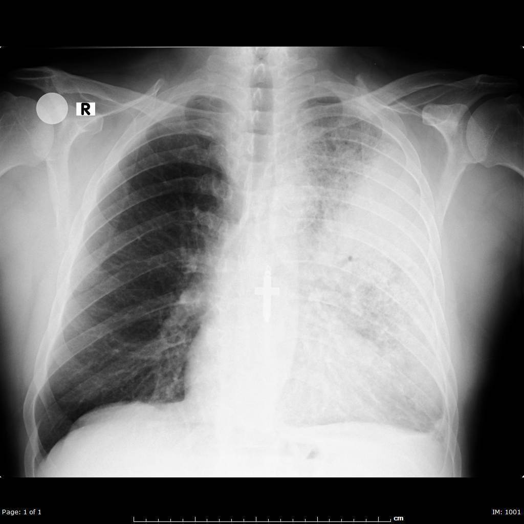 Lobar pneumonia — consolidation with air bronchogram