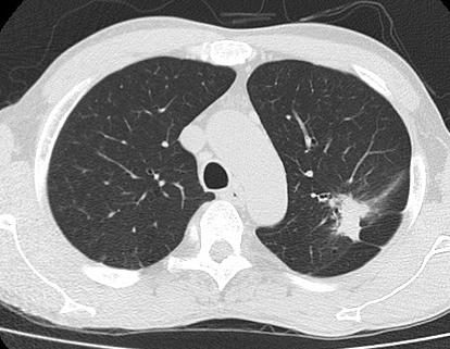 Post-primary TB — apical consolidation with satellite nodules