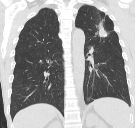 Post-primary TB — apical consolidation with satellite nodules