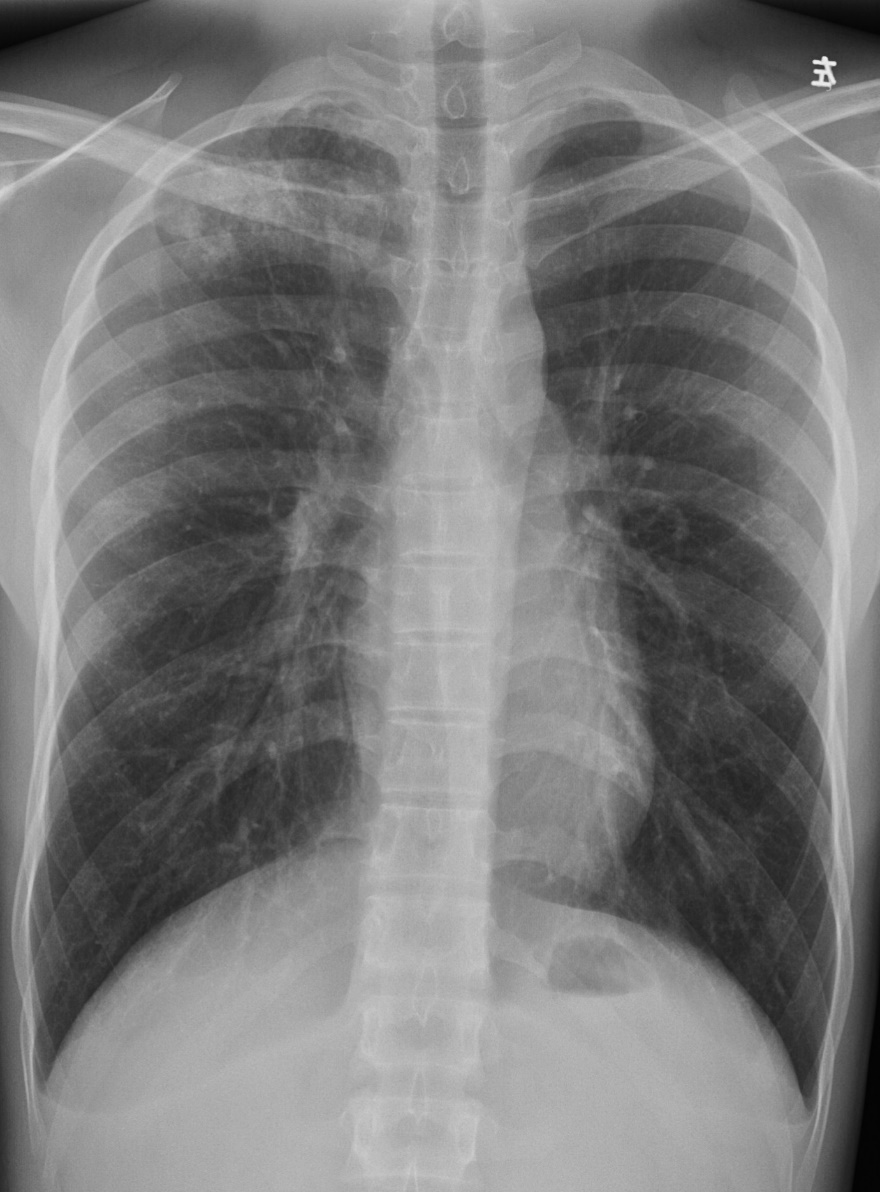 Post-primary TB — apical consolidation with satellite nodules