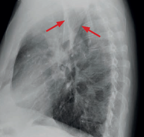 Central lung cancer — Golden S sign