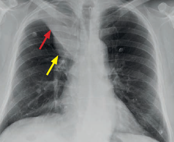 Central lung cancer — Golden S sign
