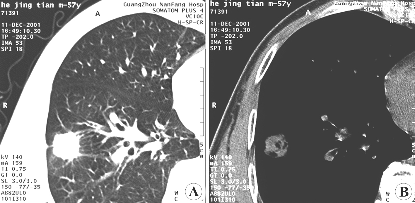 Peripheral lung cancer — spiculated mass with pleural depression