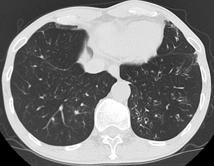 Bronchiectasis — dilated thick-walled bronchi on HRCT