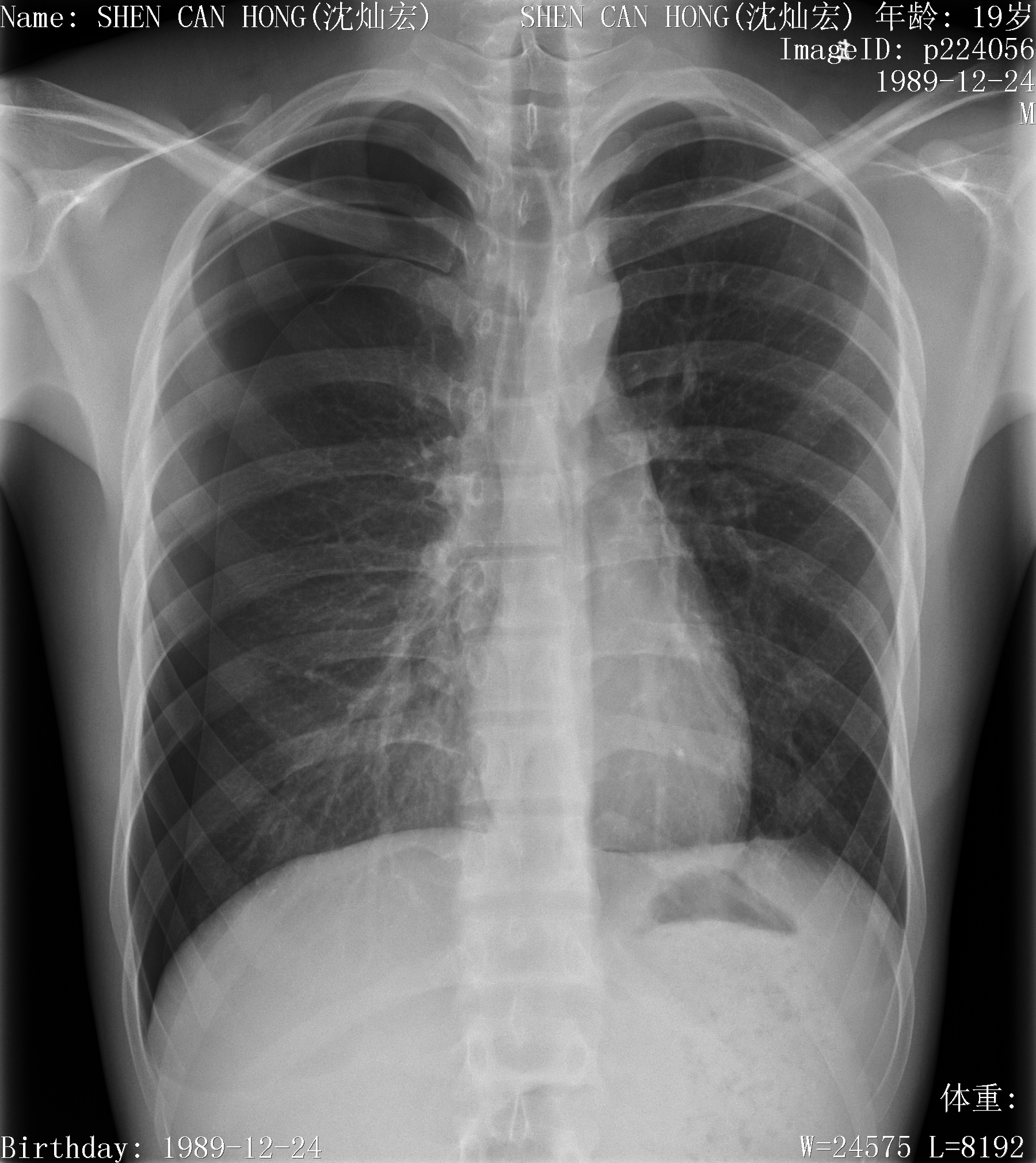 Pneumothorax — visceral pleural line, mediastinal shift