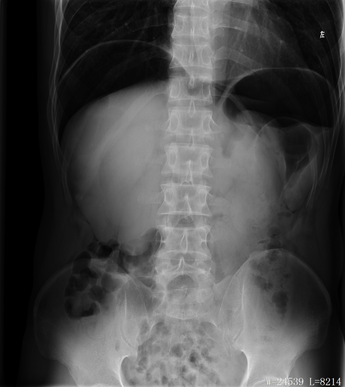 Pneumoperitoneum — free air under the diaphragm