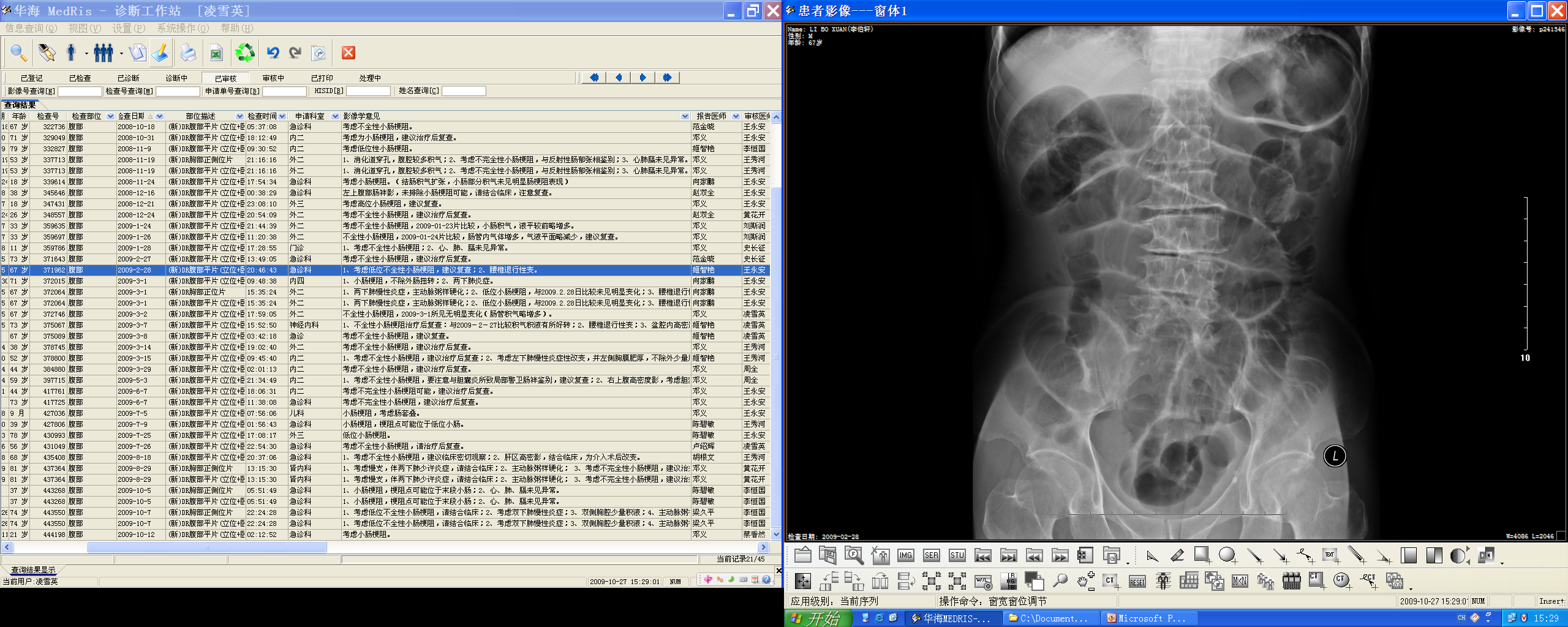 Small bowel obstruction — dilated loops, air-fluid levels