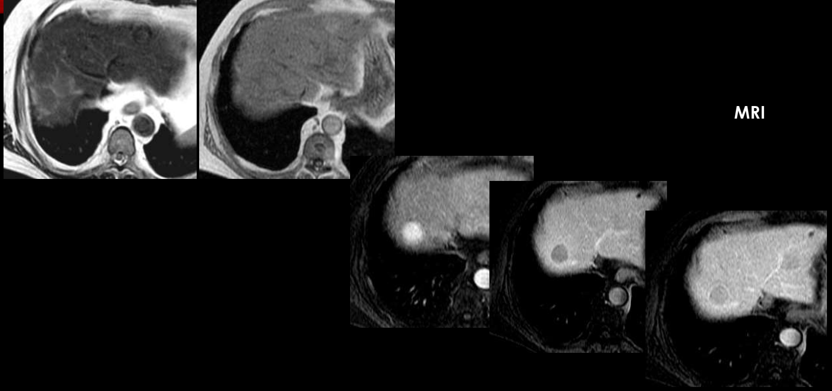 HCC — arterial enhancement with washout