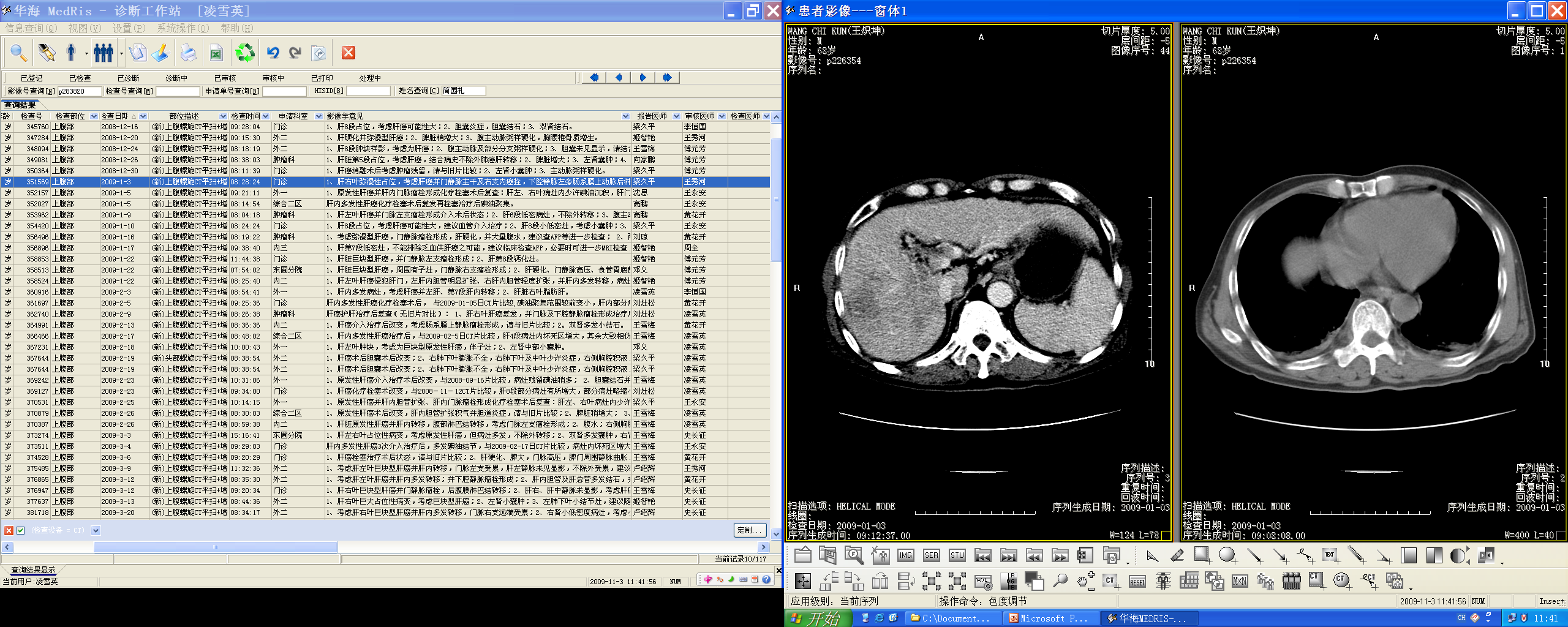 HCC — arterial enhancement with washout