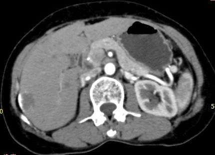Hepatic hemangioma — peripheral nodular enhancement