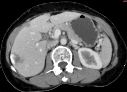 Hepatic hemangioma — peripheral nodular enhancement