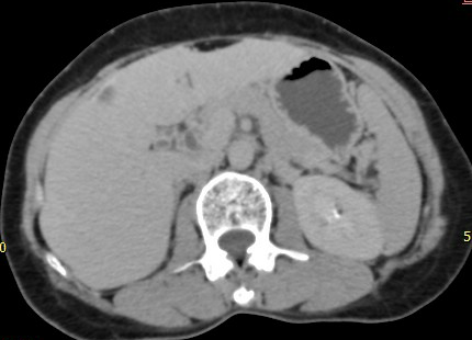 Hepatic hemangioma — peripheral nodular enhancement