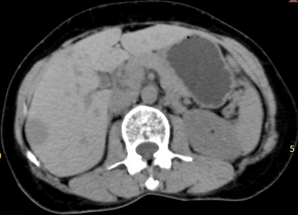 Hepatic hemangioma — peripheral nodular enhancement