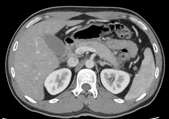Acute pancreatitis — enlarged pancreas with fat stranding