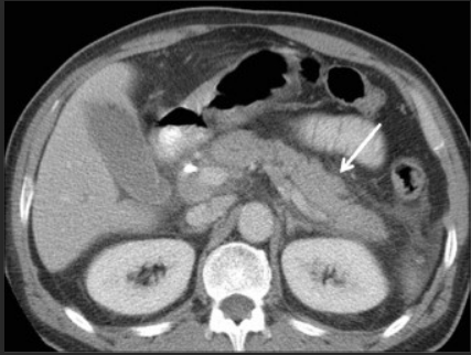 Acute pancreatitis — enlarged pancreas with fat stranding