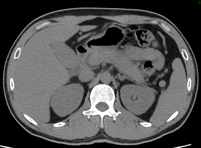 Acute pancreatitis — enlarged pancreas with fat stranding