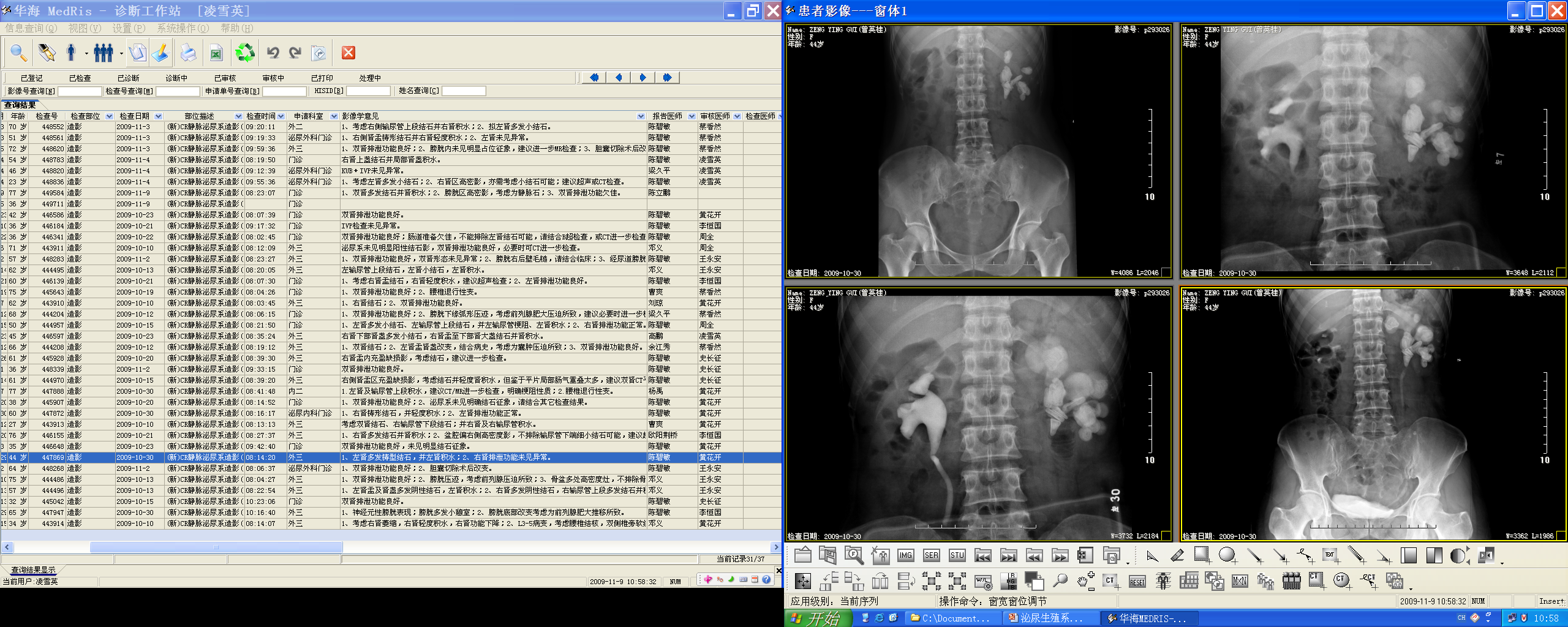 Kidney stones — CT gold standard for urinary calculi