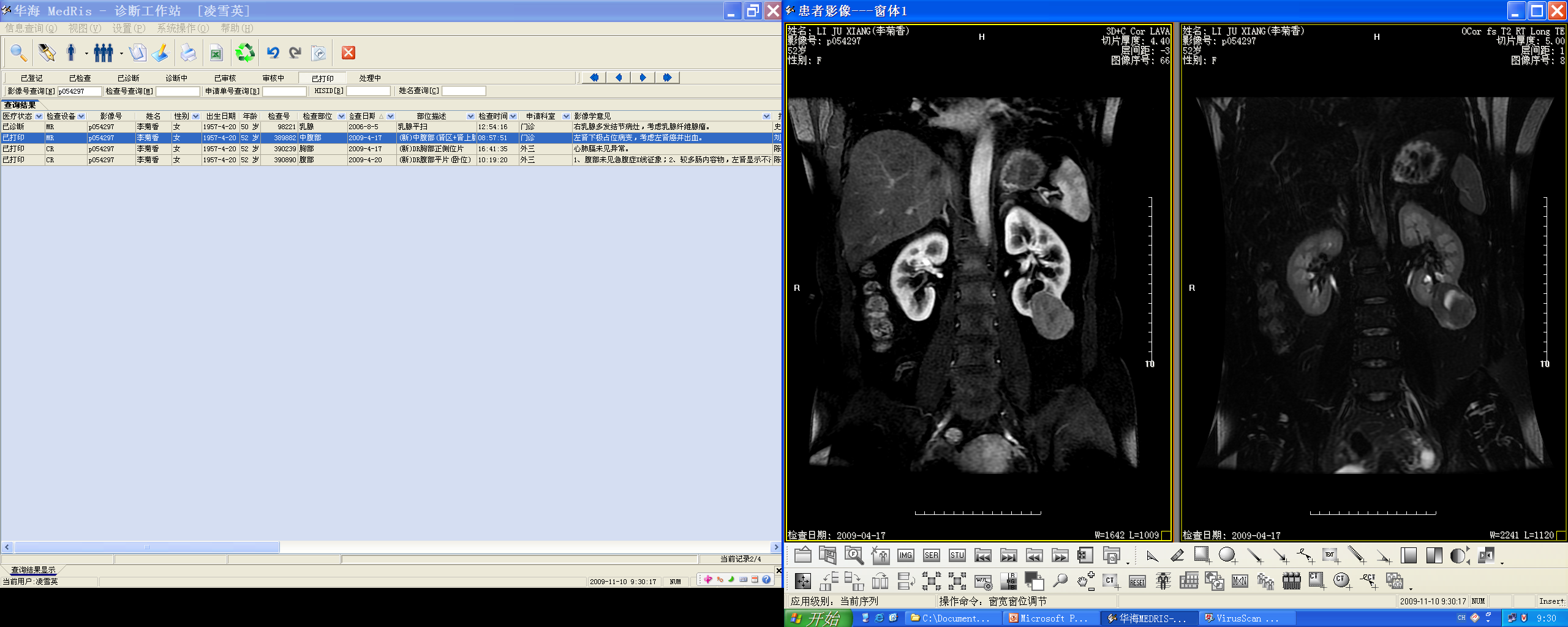 Renal cell carcinoma — enhancing renal mass