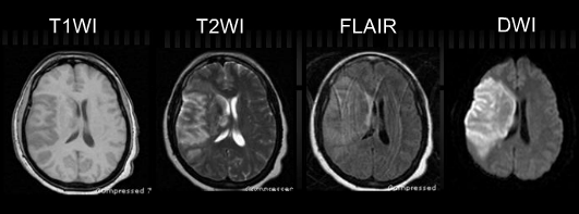 Cerebral infarction — low density in MCA territory