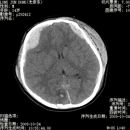 Epidural hematoma — lentiform, does not cross sutures