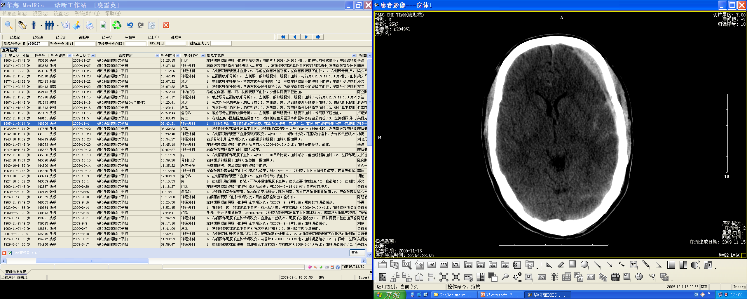 Subarachnoid hemorrhage — blood in basal cisterns