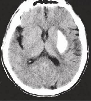 Hypertensive ICH — basal ganglia hemorrhage
