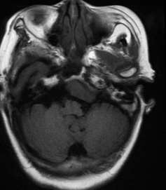 Meningioma — extra-axial mass with dural tail