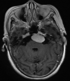 Meningioma — extra-axial mass with dural tail