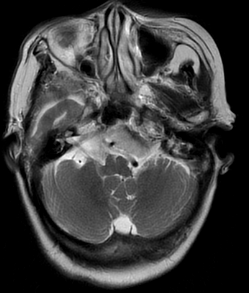 Meningioma — extra-axial mass with dural tail