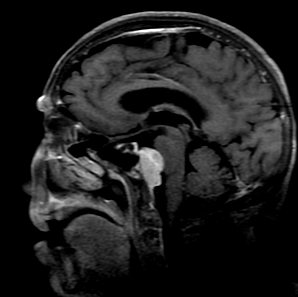 Meningioma — extra-axial mass with dural tail