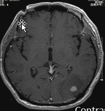 Brain metastases — gray-white junction, small nodule large edema